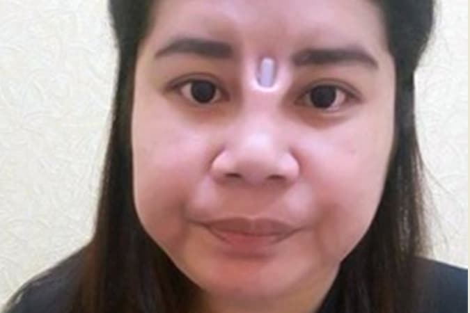 Из-за безуспешной пластики жительница Таиланда осталась с дырой между глаз