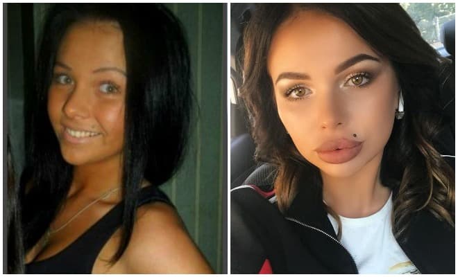 Кольпопластика до и после фото женщины