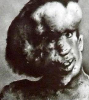 фотография Джозеф Меррик