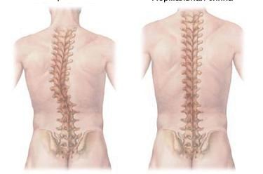 Как лечить искривление позвоночника
