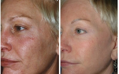 Фракционный лазерный термолиз – идеальный способ омоложения