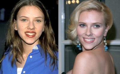 Ринопластика стала популярной на "Доме-2"