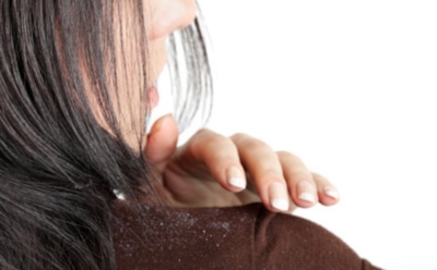 Как избавиться от перхоти?