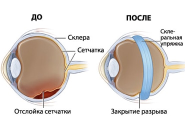 Инновационные методы лечения отслойки сетчатки глаза
