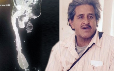 В Мексике мужчину с 45-сантиметровым половым органом признали инвалидом