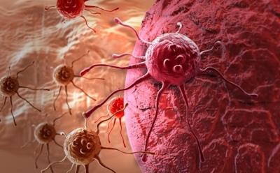 Ученые выяснили, как раковые клетки начинают «гулять» по организму