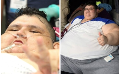 В Мексике успешно прооперировали самого тяжелого человека в мире