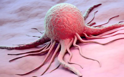 "Симптомы рака": названы неожиданные проявления смертельного недуга