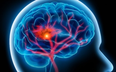 "Рассеянный склероз": медики узнали, кто рискует заболеть страшным недугом