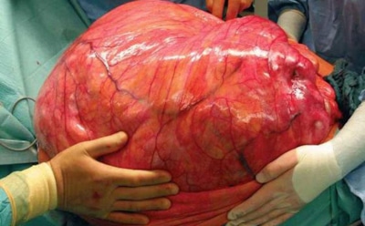 Самая большая опухоль в мире