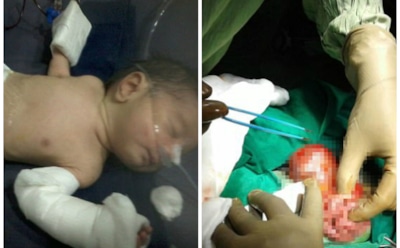 В Индии родился беременный младенец