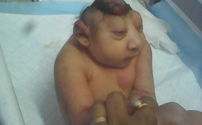 В Индии родился мальчик с мозгом наружу