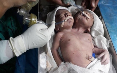 В Индии родился ребенок с двумя головами