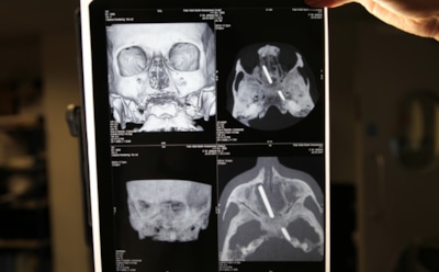 Проведена первая в истории успешная пересадка головы в Китае