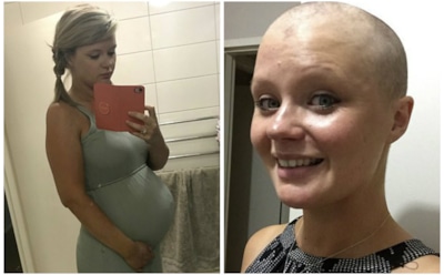 В Великобритании женщина «родила» раковую опухоль