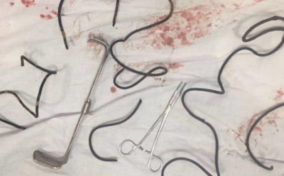 Житель Чечни 10 лет ходил с зондом в животе