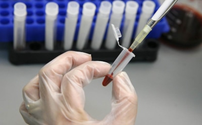 В России заболеваемость гепатитом А выросла в 1,5 раза