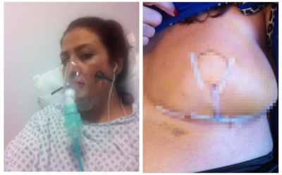 46-летней британке по ошибке удалили грудь в больнице