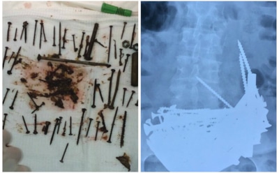 В Бурятии из желудка пенсионерки удалили 150 металлических предметов