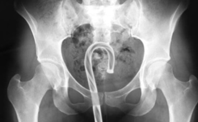 Составлен список застрявших в американцах предметов в 2017 году