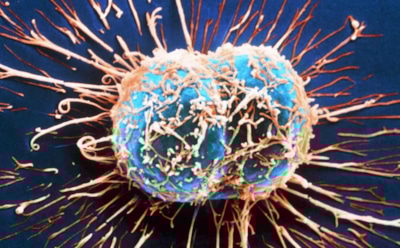 Ученые из России разработали электронную пушку для лечения рака