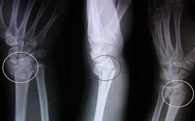 Нейросеть научили читать рентгеновские снимки лучше врачей