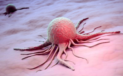 Обнаружена связь между раком груди и ожирением у женщин