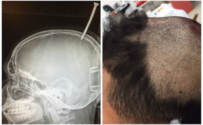 В США из черепа подростка извлекли шуруп длиной в 15 см