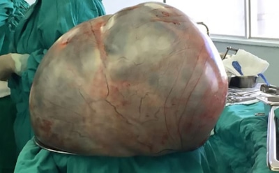 В Мексике женщине удалили самую большую опухоль в истории