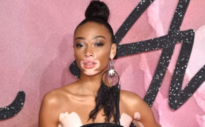 «Пятнистая модель» Винни Харлоу показала соблазнительные фото в бикини