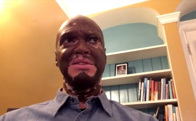 В США репортер показал измененное болезнью лицо через 25 лет притворства