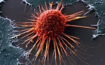 Ученые объяснили появление смертоносного рака