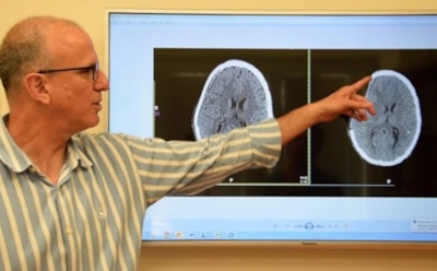 В Израиле провели пересадку напечатанного на 3D-принтере черепа