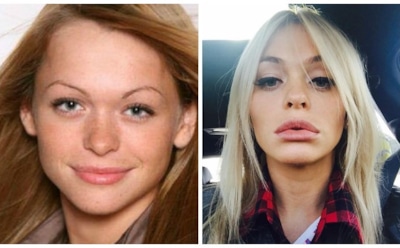 8 российских звезд, которых подозревают в увеличении губ