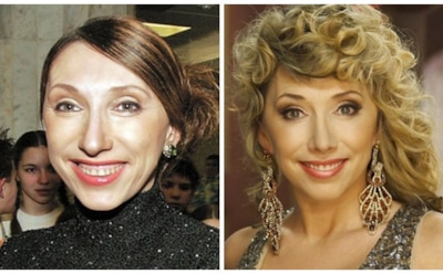 7 знаменитостей, сделавших пластику носа