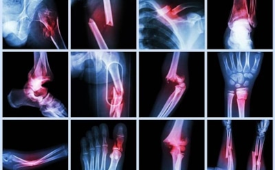 Ученые научились за считанные минуты склеивать сломанные кости