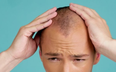 Учеными найдено новое средство для борьбы с облысением