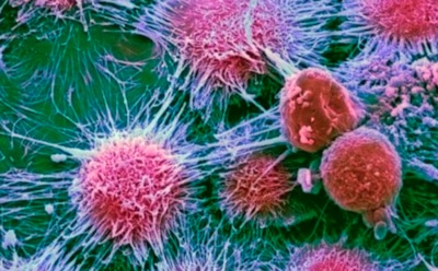 Ученые из США выявили легко устранимую причину рака