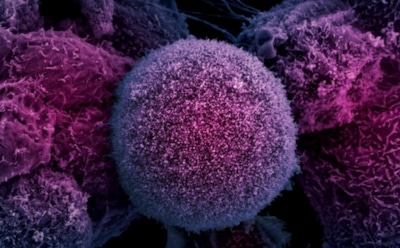 Ученые из РФ разработали метод лечения рака без химиотерапии