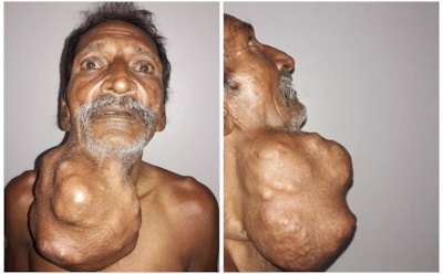 В Индии фермер 20 лет «растил» опухоль размером с голову