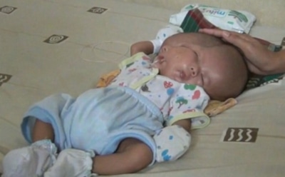 В Индонезии родился ребенок с двумя лицами