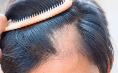 Учёные нашли способ остановить облысение