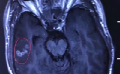 Хирурги извлекли из мозга любителя мяса 10-сантиметрового червя