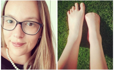 Австралийка лишилась пальцев на ноге из-за «рыбьего педикюра»