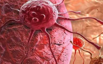 Ученые: найден способ блокировать рак до первых симптомов