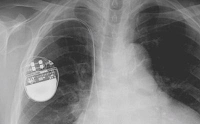 В сердечных имплантантах Medtronic нашли критичную уязвимость