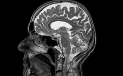 Ученые: ожирение связано с изменениями в структуре мозга