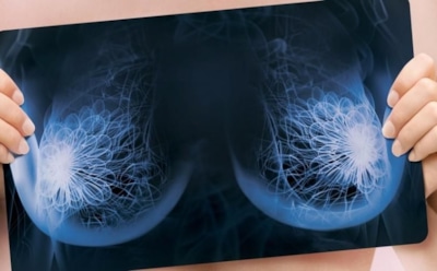 Жительница Таиланда страдает от аномального роста груди