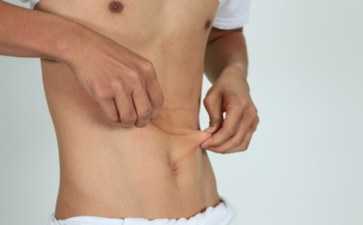 Неизвестная болезнь раздула живот 19-летнего индийца до аномальных размеров