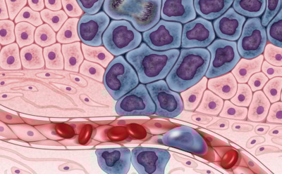 Онколог озвучил основные симптомы рака мозга